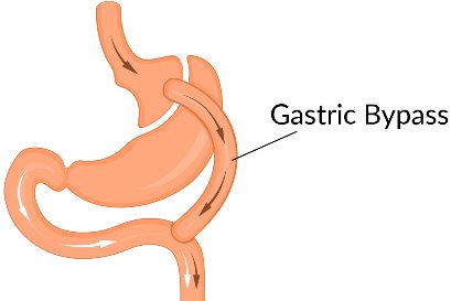 Best Gastric Bypass Surgeon in Delhi | Dr. Tarun Mittal