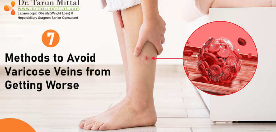 7 Methods to Avoid Varicose Veins from Getting Worse