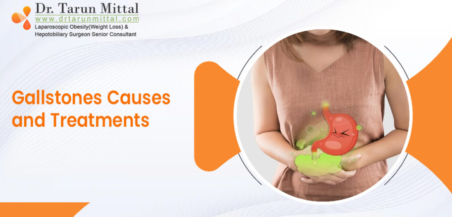 Gallstones Causes and Treatments
