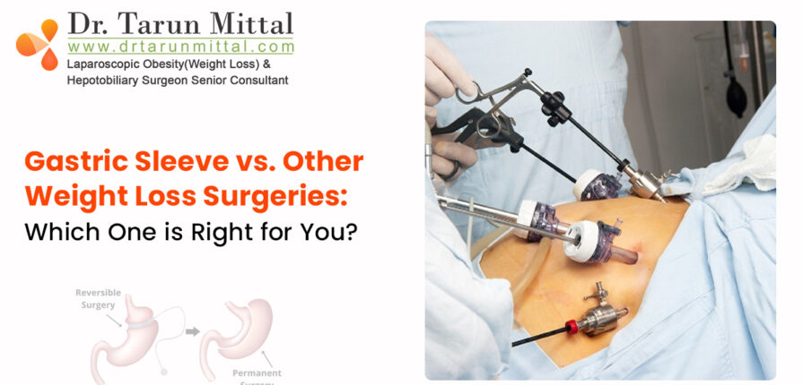Gastric sleeve surgery vs other