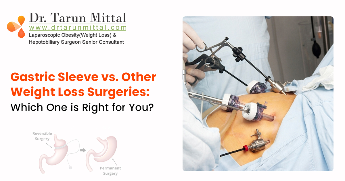 Gastric sleeve surgery vs other
