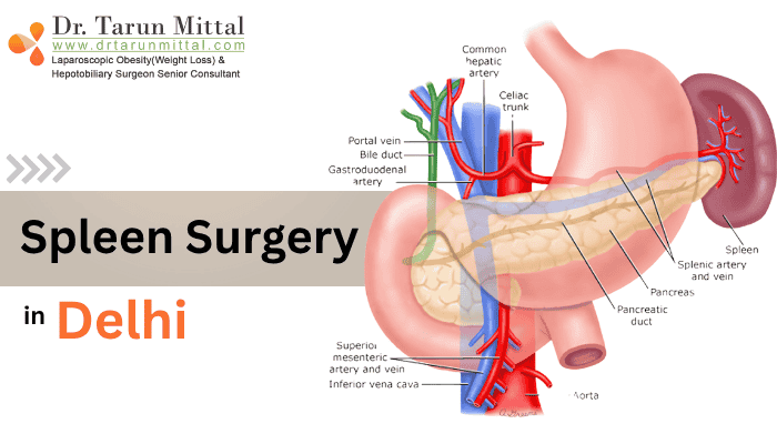 Best spleen surgery in delhi - Dr. Tarun Mittal